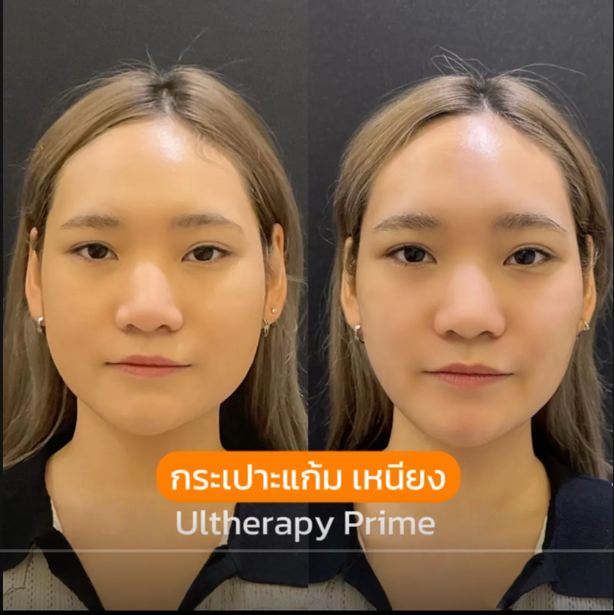 Consented Ultherapy PRIME Program review and before-and-after image for Case 01, Before and after
